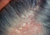Scalp Dryness