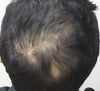 Reduced Hair Fullness